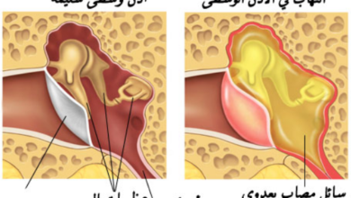 التهاب الأذن الوسطى عند الأطفال