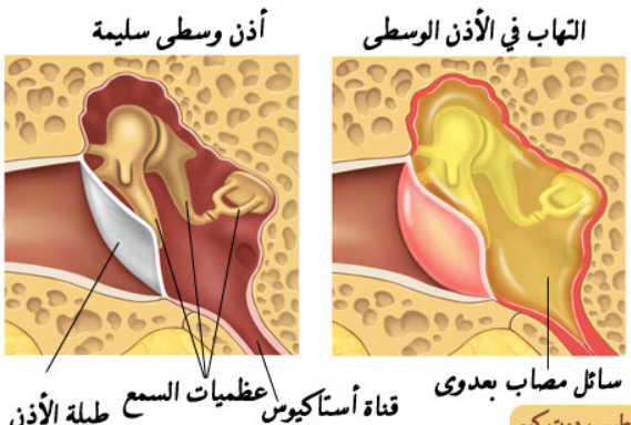 التهاب الأذن الوسطى عند الأطفال